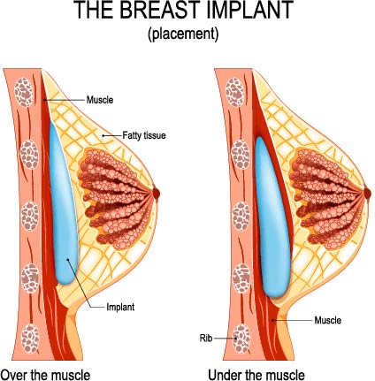 Who Can Benefit from Breast Augmentation?: Laughlin Plastic