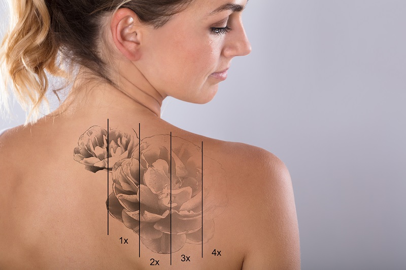 Common Questions About Laser Tattoo Removal | Greenwood